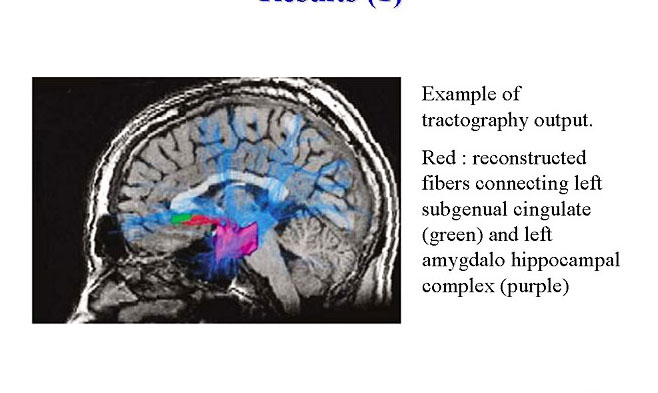 Collège de France - Neuroimagerie du trouble bipolaire / Neuroimaging of bipolar disorder