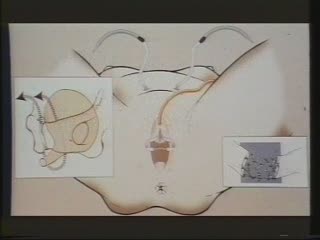 Exérèse laparoscopique d'un fragment de bandelette de T.V.T.
