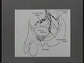 Curage ilio-obturateur par coeliochirurgie