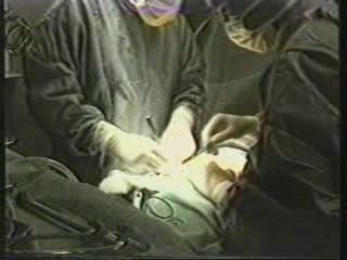 Prostatectomie radicale par voir périnéal