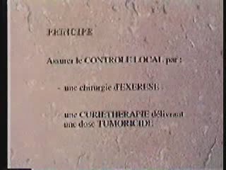 Traitement des cancers de vessie par chirurgie conservatrice et iridium 192