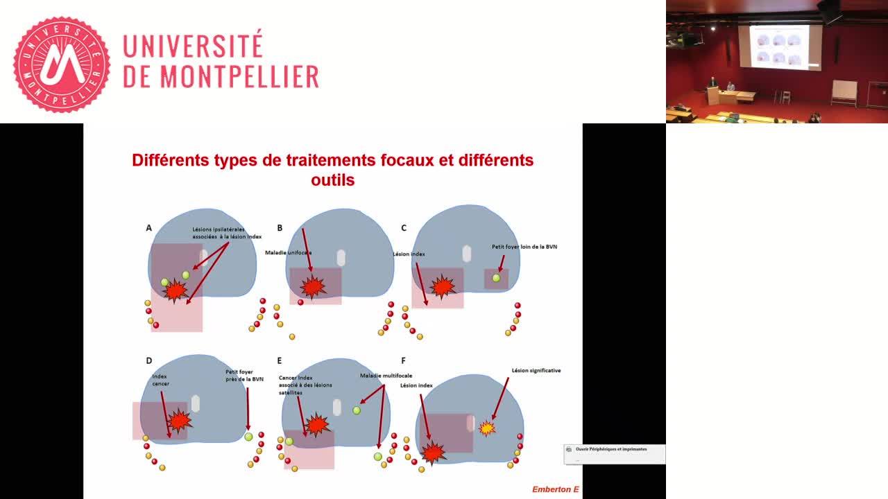 SFjRO Montpellier 2019 - Traitement focal du cancer de prostate
